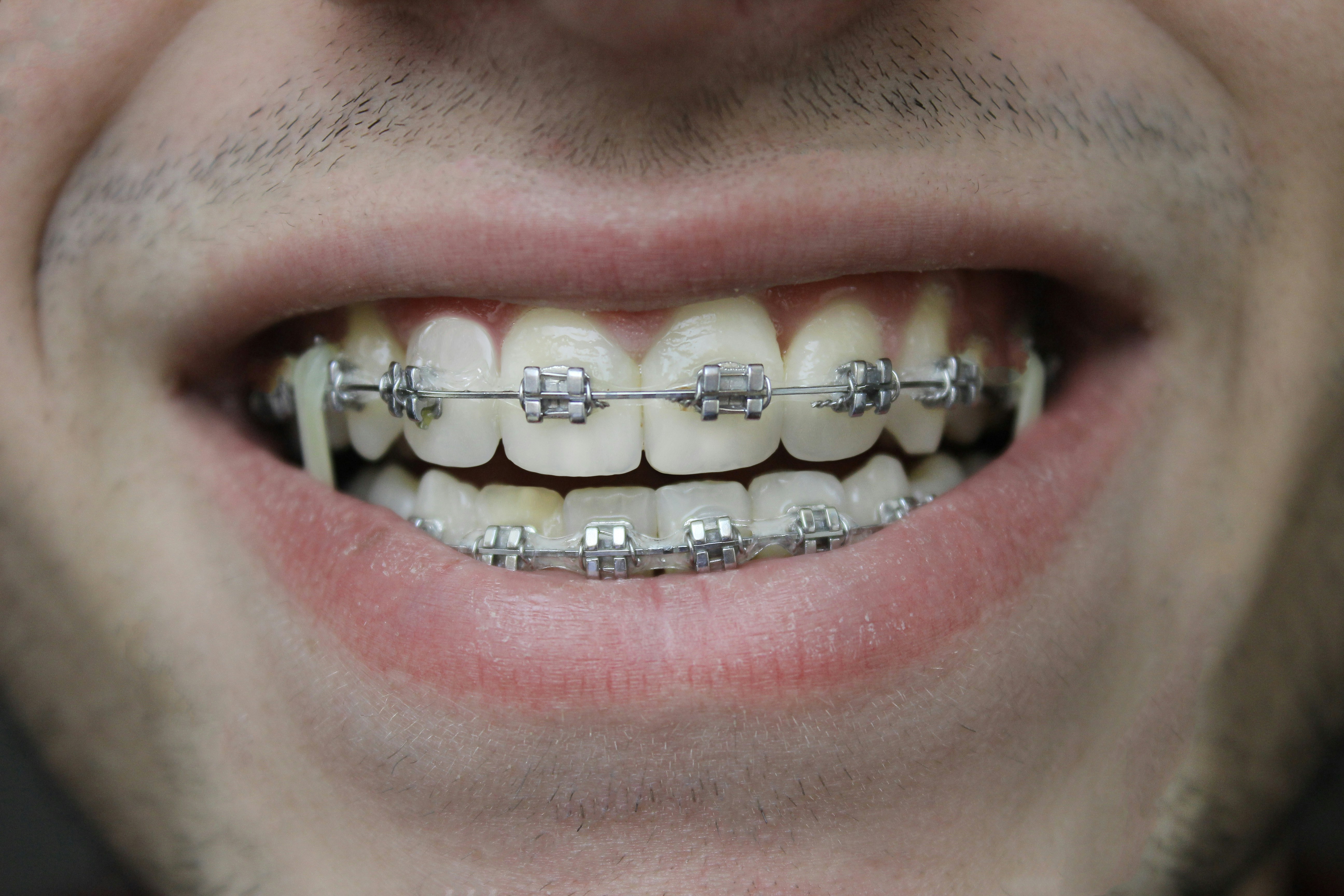 Entretien des bijoux dentaires : conseils pour un sourire &eacute;clatant